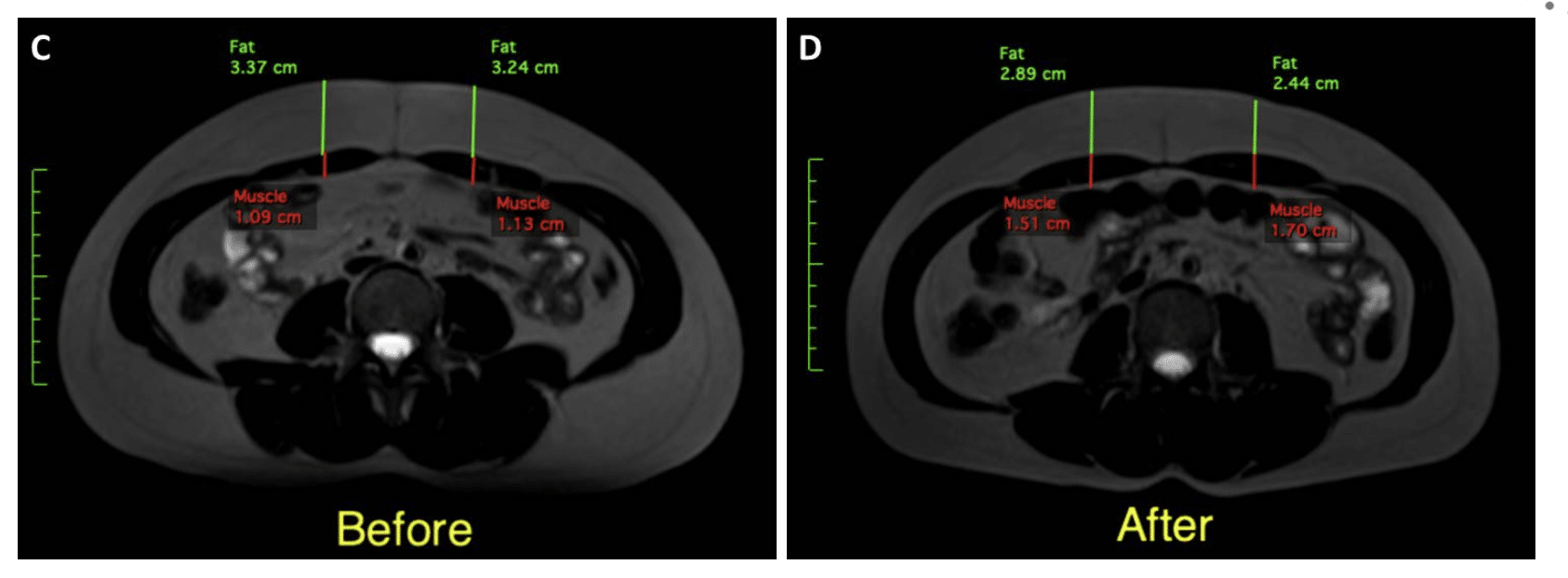 Resonancia Magnética Zona Abdominal