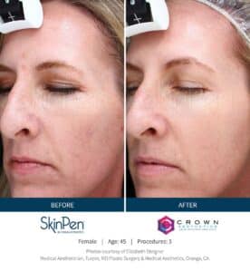 SkinPen Caso 3