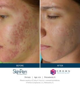 SkinPen Caso 1